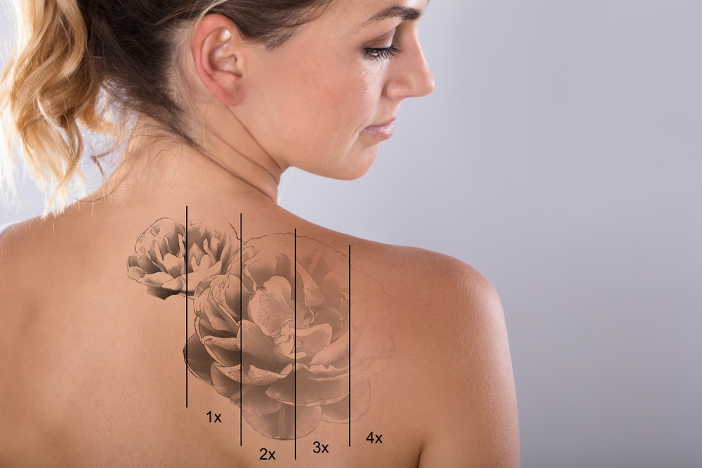 Santa Rosa Laser Tattoo Removal for Unwanted Ink